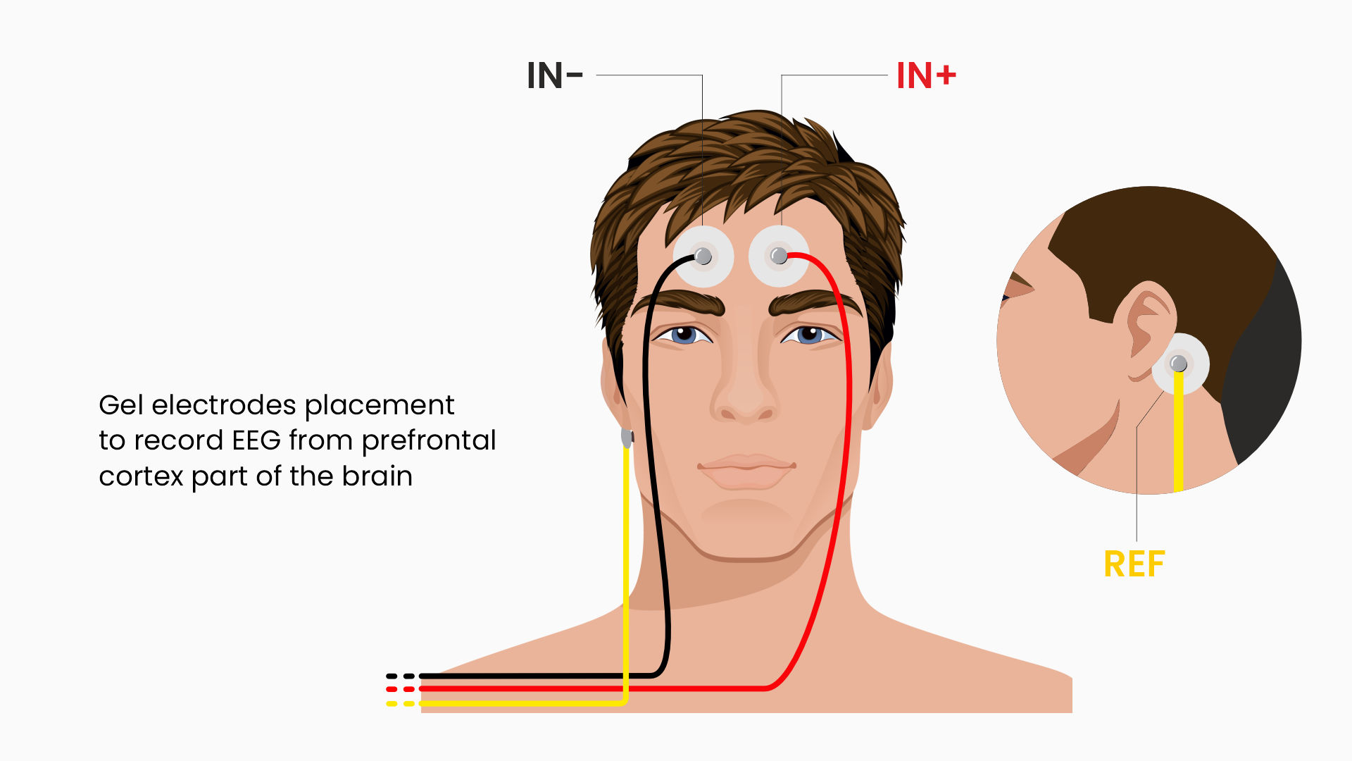 Electrode placement for EEG