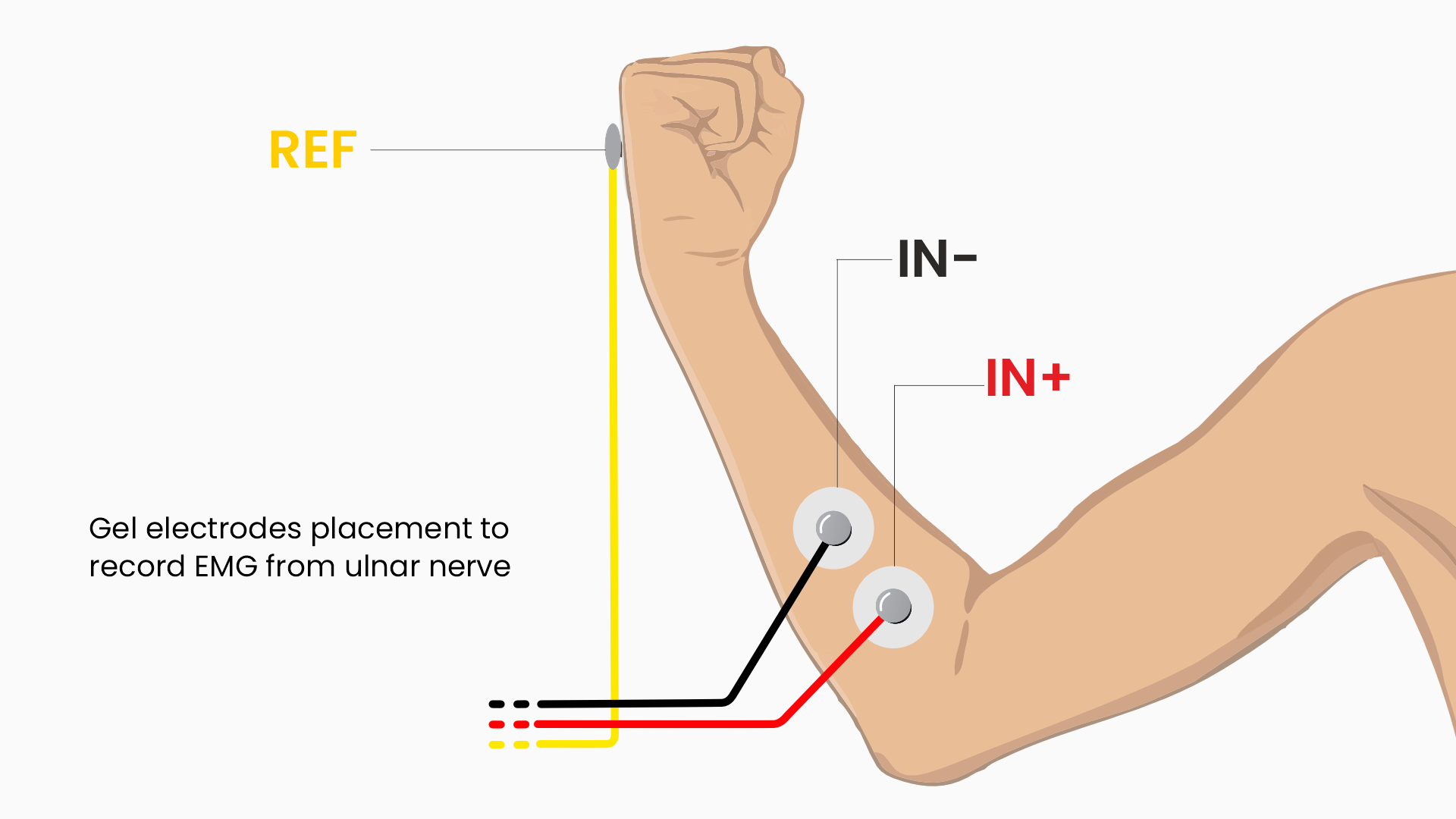 Electrode placement for EMG