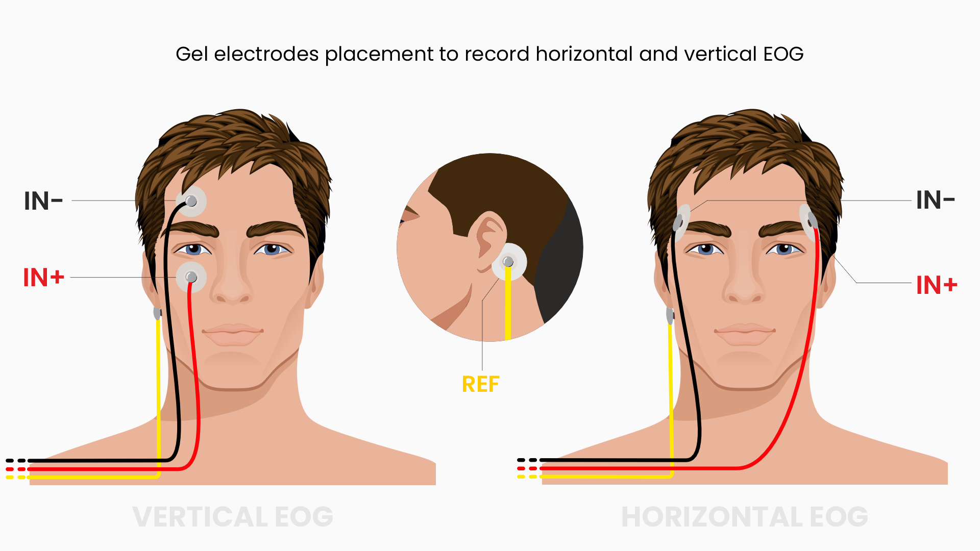 Electrode placement for EOG